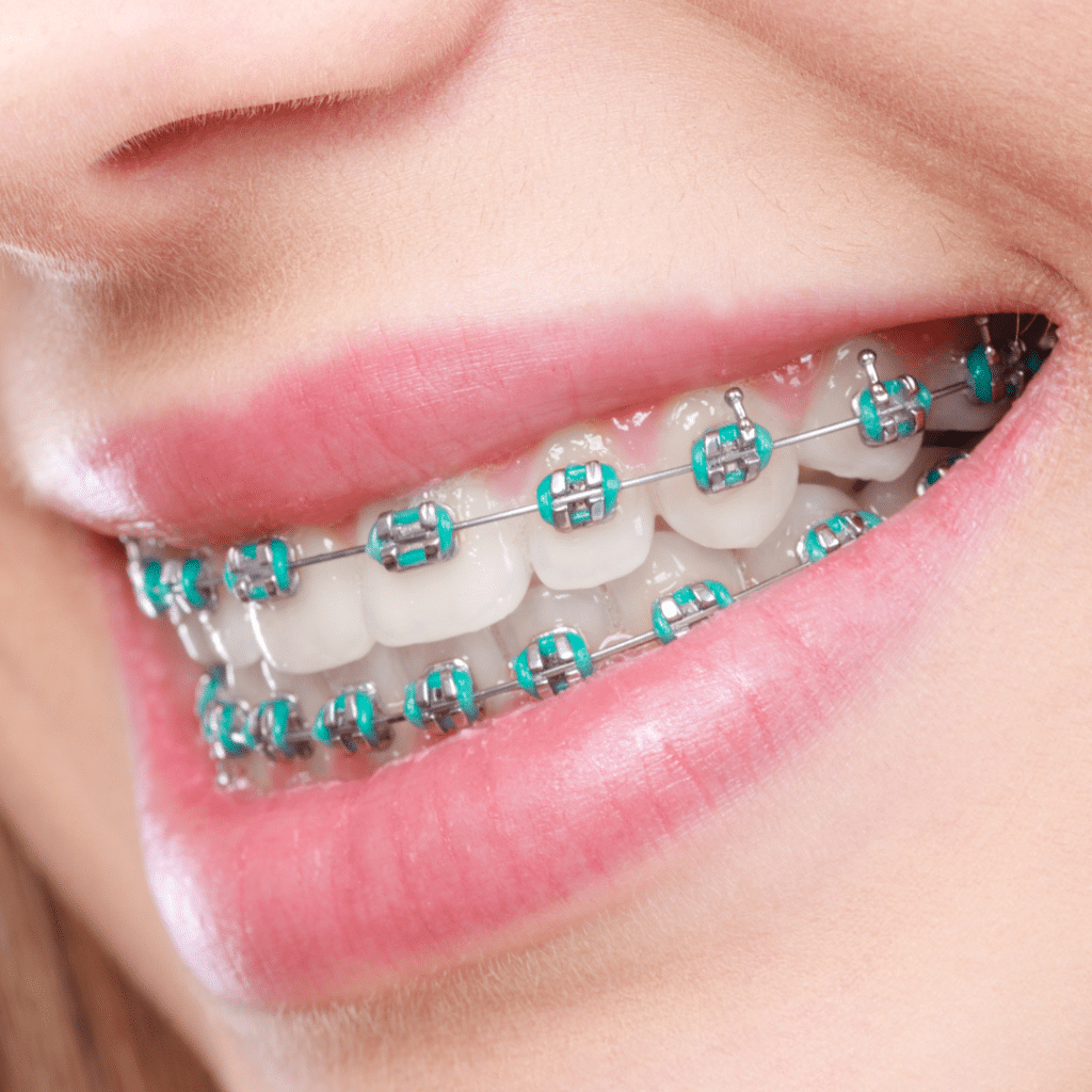 Traditional Metal Braces: Classic but Cool