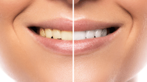 Teeth_Whitening_Comparison