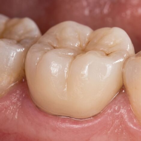 same day dental crown