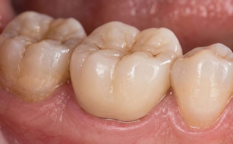 same day dental crown