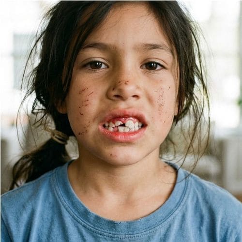 Dental Trauma or Injury
