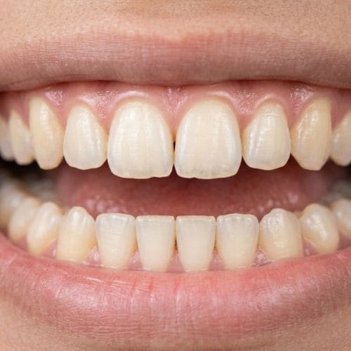 Restoring Broken Teeth